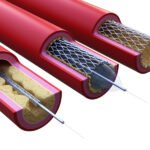 top 5 stent companies in India