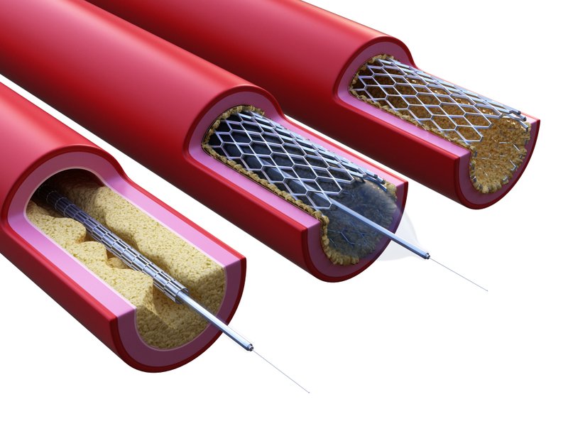 top 5 stent companies in India